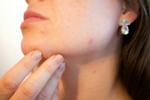 Acné, dermatose chronique inflammatoire et pustuleuse