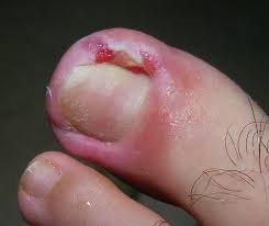Manifestations des ongles incarnés : rougeur, inflammation, gonflement, douleur, ...