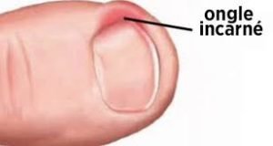 Ongles incarnés, pénétration anormale des côtés des ongles dans la chair adjacente