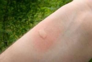 Les piqûres d'insecte peuvent être bénignes ou dangereuses, pouvant causer un choc anaphylactique