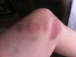 Contusion