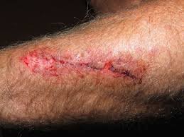 Coupures, blessures et abrasions