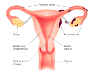 Endométriose