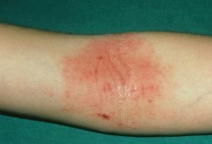 Eczéma, affection prurigineuse de la peau