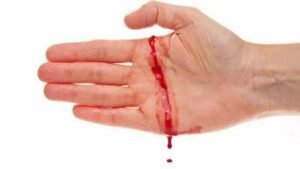 Manifestations de l'hémophilie : difficulté dans la coagulation en cas de saignement, hémorragies spontanées sans lésions, ...