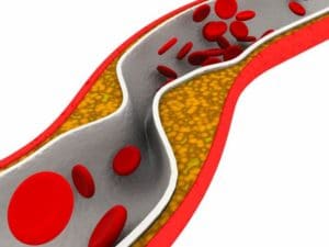 L'hypertriglycéridémie favorise l'accumulation de graisses sur les parois artériels