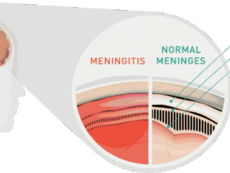 Méningite