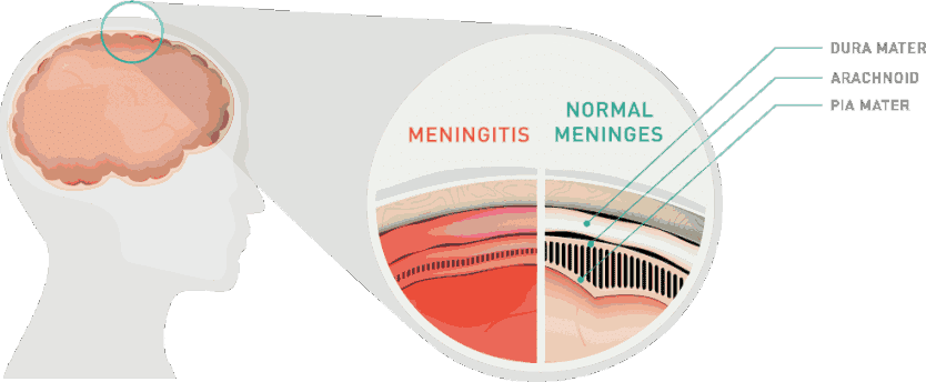 Méningite