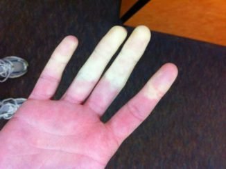 maladie de raynaud