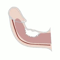Maladie de La Peyronie, affection de la verge se caractérisant par une rigidification pathologique des corps caverneux