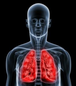 Mucoviscidose, ou fibrose kystique, maladie des revêtements épithéliaux affectant divers organes et rendant plus visqueux le mucus