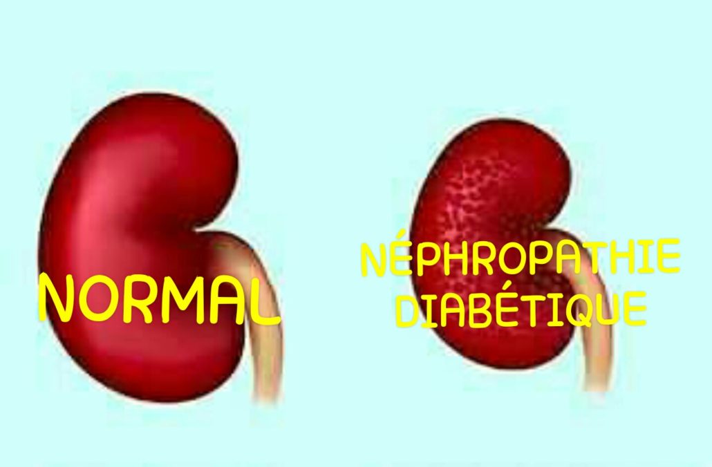 Néphropathie diabétique