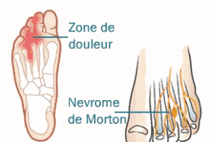 Névrome de Morton, ou métatarsalgie de Morton, maladie caractérisée par une très forte douleur ressentie au pied