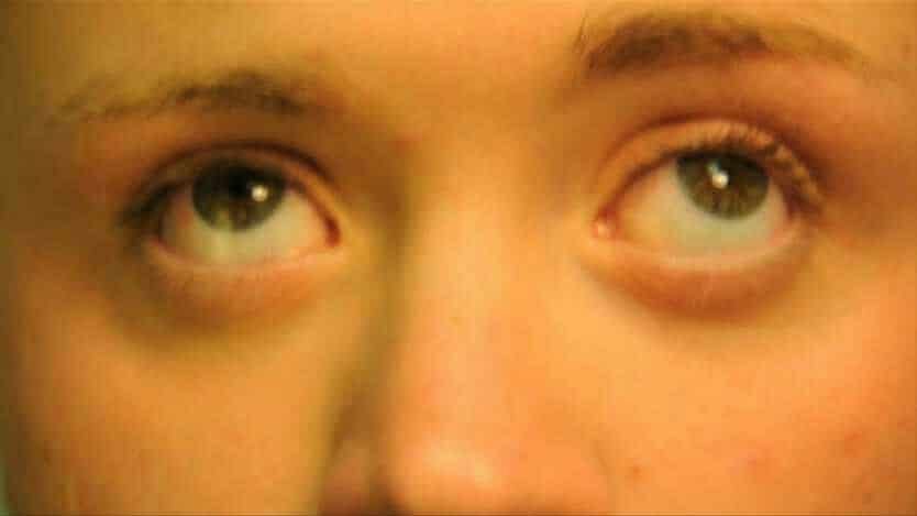 Les Yeux En Bas A Droite Snap Nystagmus : Causes ? Symptomes? Quels traitements naturels