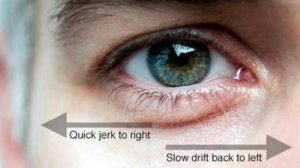 Nystagmus, perturbation de la fixation du globe oculaire