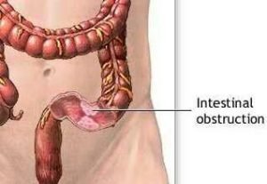 Obstruction du côlon, fermeture pathologique du gros intestin, entravant la sortie des gaz et des matières fécales