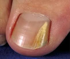 Onychomycose, ou mycose des ongles, affection parasitaire causée par des champignons microscopiques