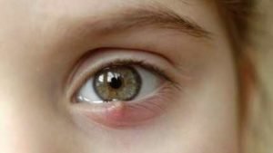 Orgelet, hordéole ou compère-Loriot, infection du follicule pileux d'un cil due au Staphylococcus aureus