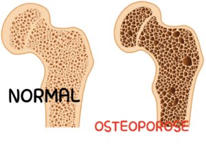 Ostéoporose, altération progressive de masse osseuse due à une augmentation anormale de la porosité des os