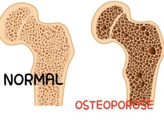Ostéoporose