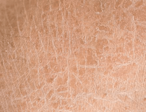 Manifestations de la peau sèche : Surface rugueuse, prurit, squames, pustules, ...