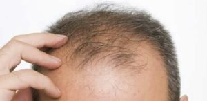 Manifestations de la perte de cheveux pour l'homme