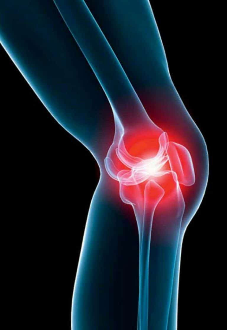 Arthrose Savoir identifier cette maladie articulaire