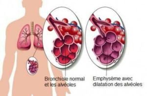Emphysème pulmonaire, affection des poumons caractérisée par la dégradation des alvéoles
