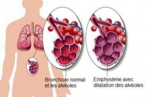 Emphysème pulmonaire, affection des poumons caractérisée par la dégradation des alvéoles 