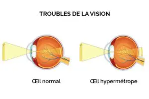 L'hypermétropie est un trouble visuel caractérisé par une vision de près floue