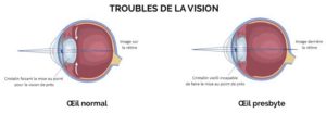 Presbytie, trouble de la vision lié au vieillissement oculaire
