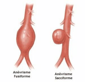 Les symptômes de l'anévrisme dépendent de sa forme et de l'endroit où il se trouve, cérébral, abdominal, ou autres