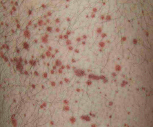 Purpura, apparition de plusieurs petites taches rouges à pourpre sur la peau ou les muqueuses