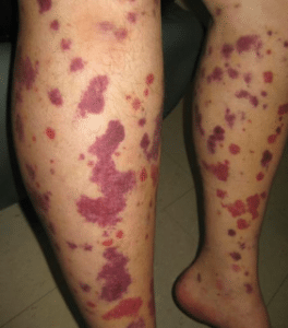 Symptômes du purpura : taches ou traces linéaires rouges, gonflement, hématome, fièvre en cas d'infection, ...
