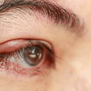 Manifestations de la blépharite : rougeur, brûlure, squames, œdème, infection, ulcère, ...