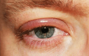 La blépharite est une inflammation du bord des paupières