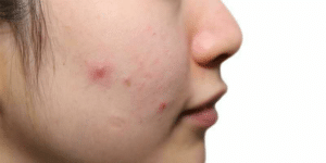 Papule, gonflement de la peau ne renfermant ni liquide ni pus