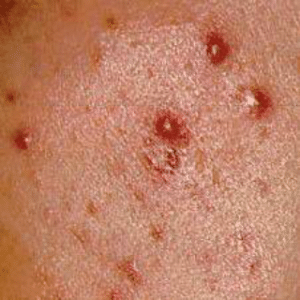 Manifestations de la papule : boutons secs de couleur rose, rouge ou brune, diamètre variable ne dépassant pas 5mm, démangeaisons, ...