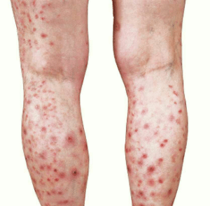 Manifestations du prurigo : apparitions de papules, prurit, coloration rouge, ...