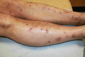 Prurigo, lésion dermatologique avec surélévations prurigineuses