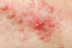 Manifestations de la pustule : éruptions cutanées, macules, prurit, fièvre, ganglions, ...
