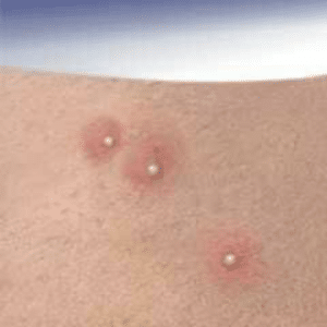 Pustule, dermatose inflammatoire avec des boutons renfermant des pus
