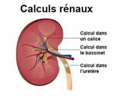 Calculs rénaux