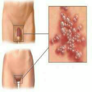 Chlamydia,