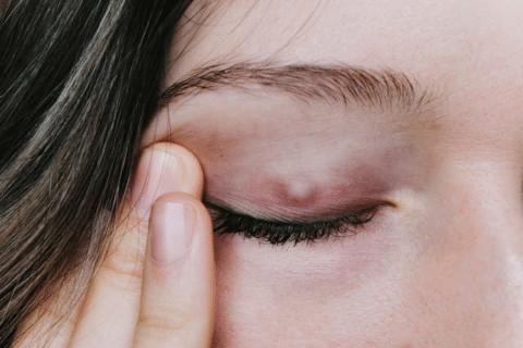 Chalazion