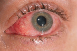 Conjonctivite, c'est l'inflammation de la conjonctive