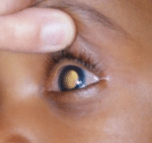 Rétinoblastome, cancer intraoculaire qui touche surtout les enfants de moins de 5 ans