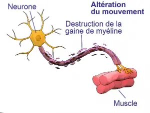 Effets de l'hydroxycitrate sur les scléroses en plaque