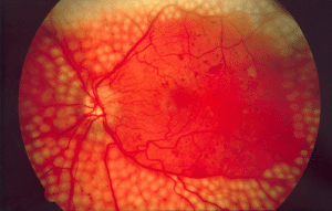 Rétinopathie diabétique, une des complications du diabète caractérisée par une atteinte de la rétine