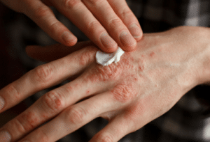 Rhumatisme psoriasique, trouble articulaire dû à des complications d'un psoriasis